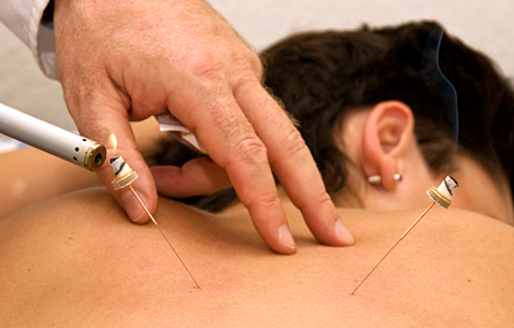 Akupunktur Akupunktur